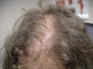 BEFORE using BllinG Hair Restoration products