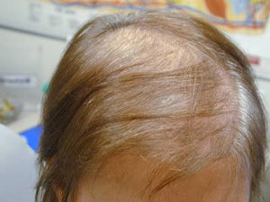 BEFORE using BllinG Hair Restoration products